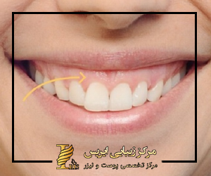 در لبخند لثه ای لب بالایی هنگام لبخند زدن بیش از حد از دندان های بالایی بالاتر می رود
